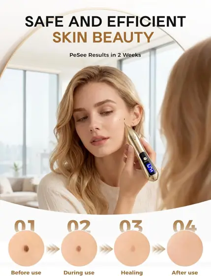 USB Rechargeable Skin Tag Remover… — Photo 4